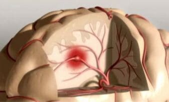 Síndromes Clínicos Cerebrovasculares