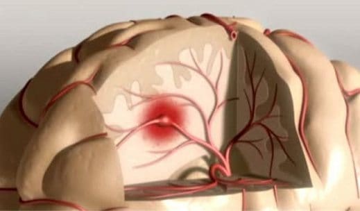 Síndromes Clínicos Cerebrovasculares