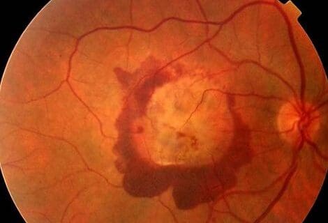 Degeneración Macular “Seca”