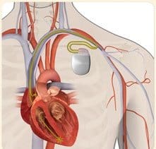 Nuevo Desfibrilador Implantado