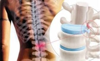 Pistas para el Dolor de la Hernia de Disco