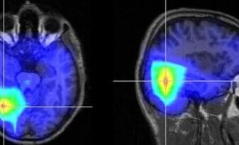 Enfermedad Cardiaca y Accidente Cerebrovascular