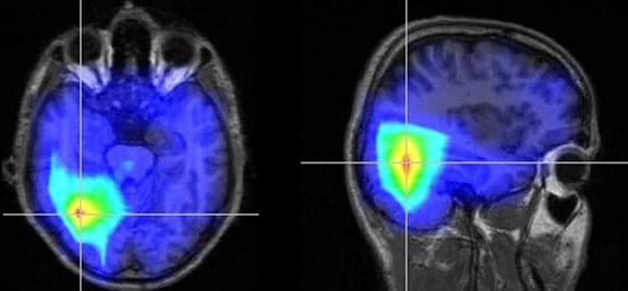 Enfermedad Cardiaca y Accidente Cerebrovascular