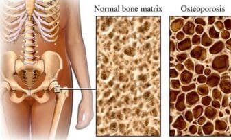 Fármaco Cura la Osteoporosis en Ratones