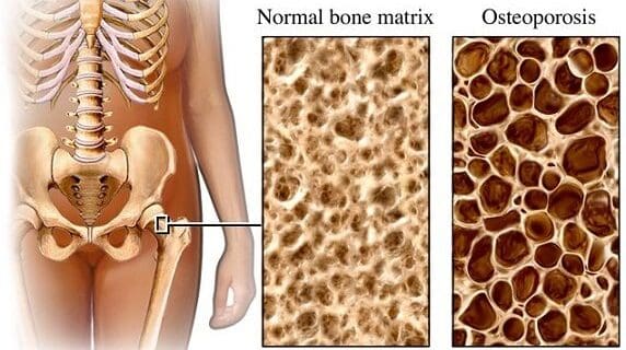 Fármaco Cura la Osteoporosis en Ratones