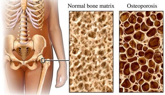 Fármaco Cura la Osteoporosis en Ratones