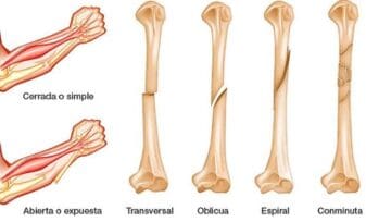 Relación entre Medicamentos para los Huesos y Fracturas