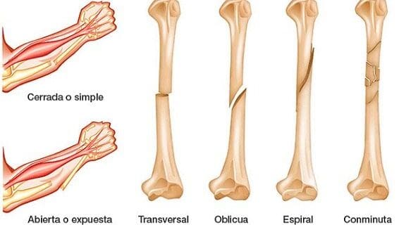 Relación entre Medicamentos para los Huesos y Fracturas