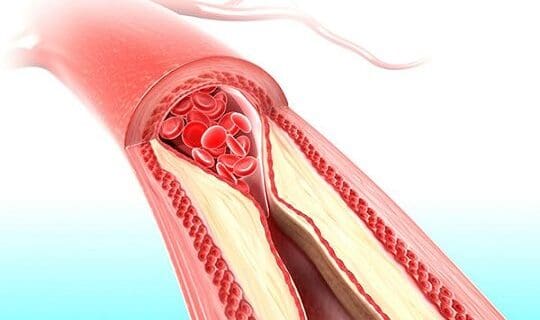 Medicamento para la Diabetes reduce la Obstrucción Arterial