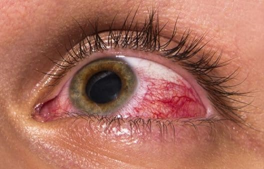 Aliviar la Presión Ocular Podría Retrasar el Glaucoma