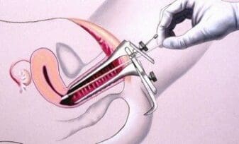 Prueba del VPH supera a la prueba de Papanicolaou