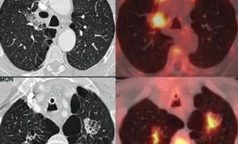 Neoplasias Pulmonares Broncogénicas, Fisiopatología