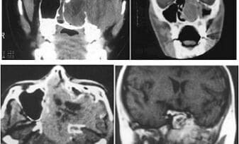 Angiofibroma Nasofaríngeo Juvenil