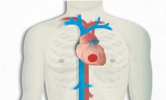 Resultados en Pacientes con cardiopatía isquémica