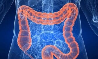 El Cáncer de Colon Ocupa la Tercera Causa de Muerte a nivel Mundial y la Cuarta en Colombia