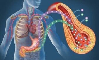 Diabetes por Pancreatectomía