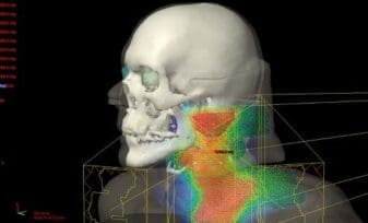 Estudio halla Variaciones en las dosis de Radioterapia