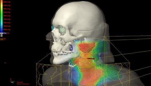 Estudio halla Variaciones en las dosis de Radioterapia