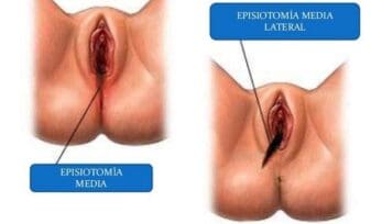 Episiotomía ¿Rutinaria?