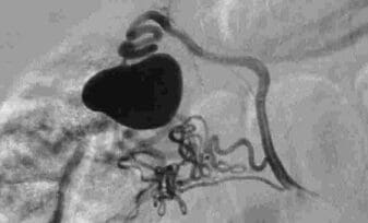 Estenosis de la Arteria Renal