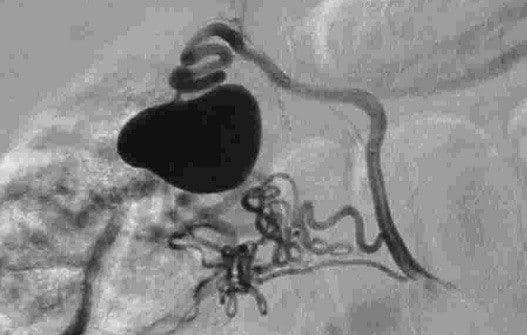 Estenosis de la Arteria Renal