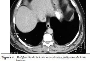 Colección grasa yuxtacava: variante anatómica que simula un tumor graso. Diagnóstico con TAC