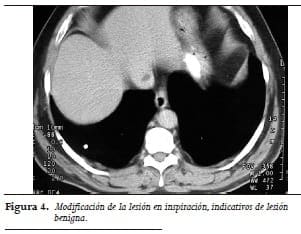 Colección grasa yuxtacava: variante anatómica que simula un tumor graso. Diagnóstico con TAC