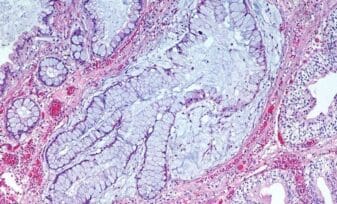 Genes Relacionados con la Gravedad de la Fibrosis Quística