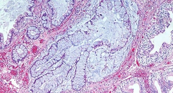 Genes Relacionados con la Gravedad de la Fibrosis Quística