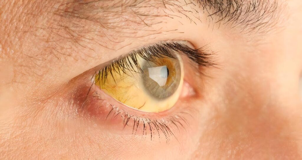 Hipertrofia benigna de la próstata