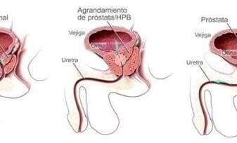 Hipertrofia benigna de la próstata