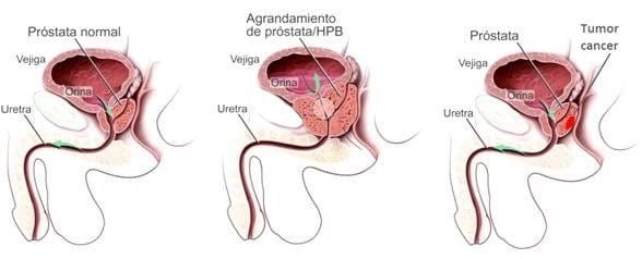 Hipertrofia benigna de la próstata