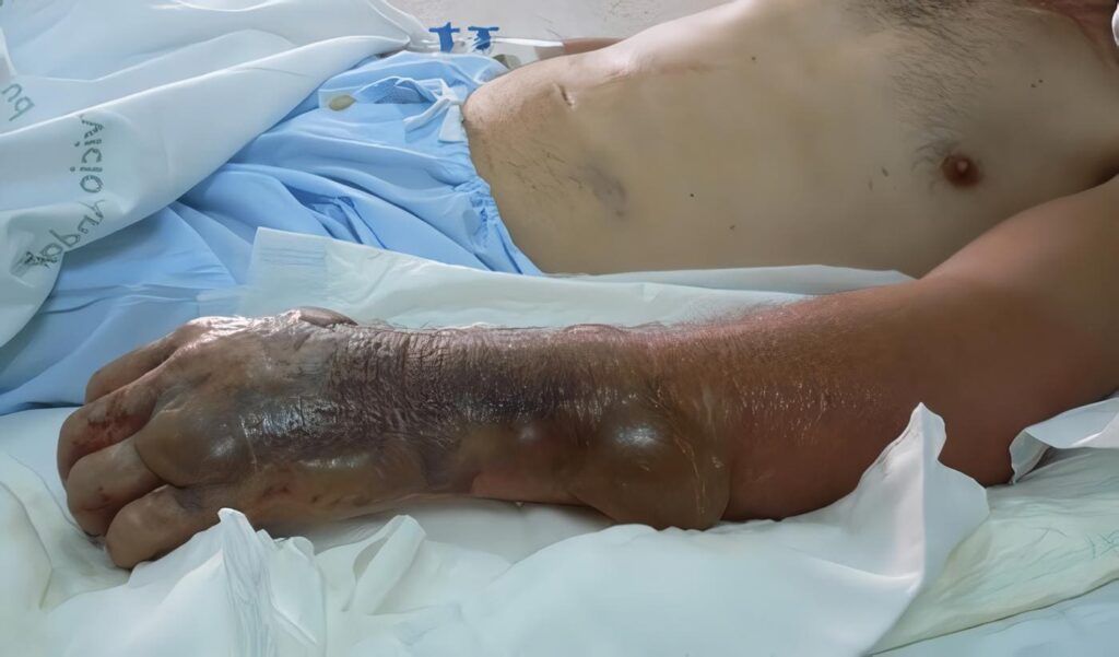 Lesiones por Descarga Eléctrica