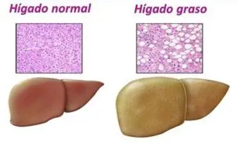 Infiltración Grasa del Hígado