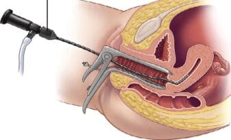 Legrado y cepillado endocervical. Artículos originales