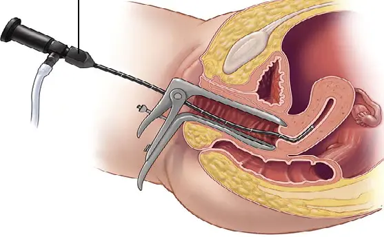 Legrado y cepillado endocervical. Artículos originales