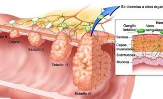 Lesiones de Colon no Poliposas son difíciles de detectar