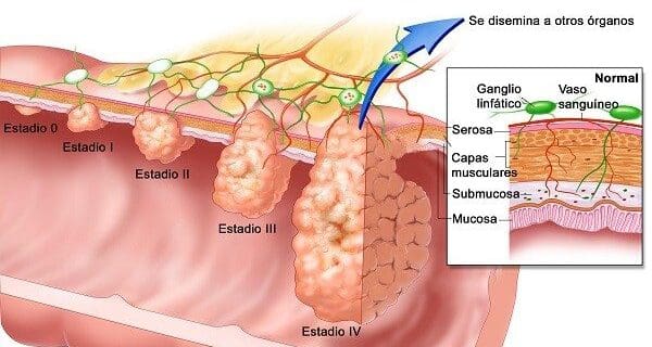 Lesiones de Colon no Poliposas son difíciles de detectar