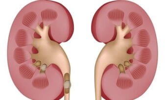 Litiasis Renal