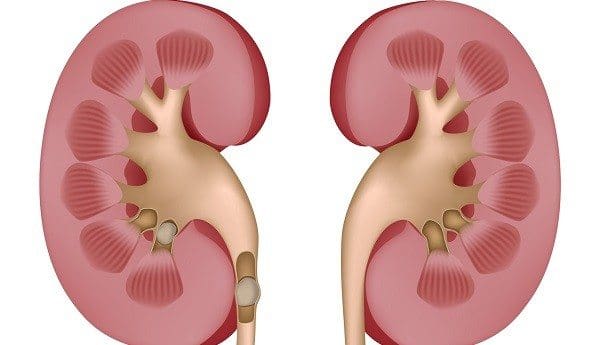 Litiasis Renal