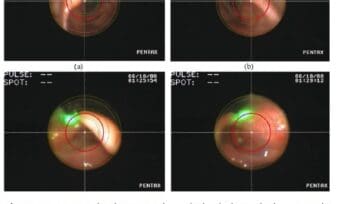 La Medición Clínica de los Umbrales sensoriales Laringofaríngeos y el Desarrollo del LPEER