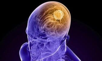 Mutaciones Genéticas y Cáncer Cerebral Mortal