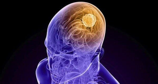 Mutaciones Genéticas y Cáncer Cerebral Mortal