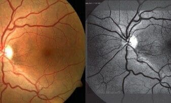 Neuropatía Óptica Epidémica Cubana