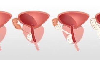 Prostatectomía Radical Laparoscópica