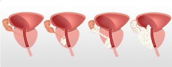 Prostatectomía Radical Laparoscópica